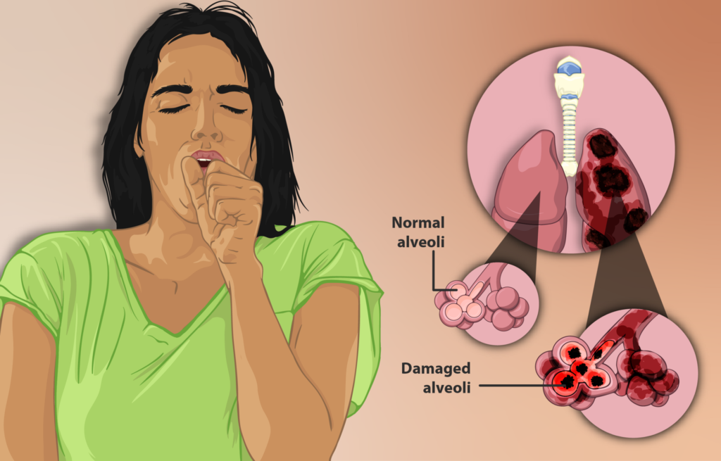 Depiction_of_a_woman_suffering_from_Emphysema,_a_type_of_Chronic_Obstructive_Pulmonary_Disease.png